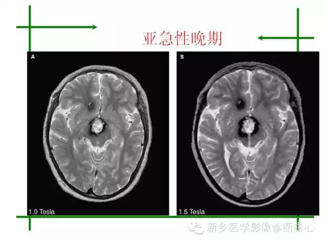 脑出血的CT和磁共振分期图解