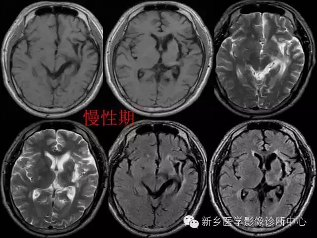 脑出血的CT和磁共振分期图解