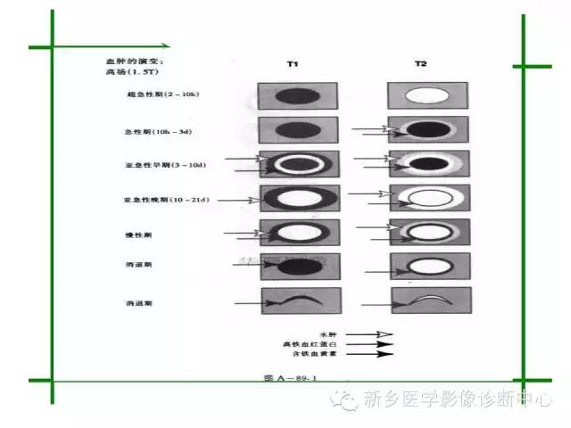 脑出血的CT和磁共振分期图解