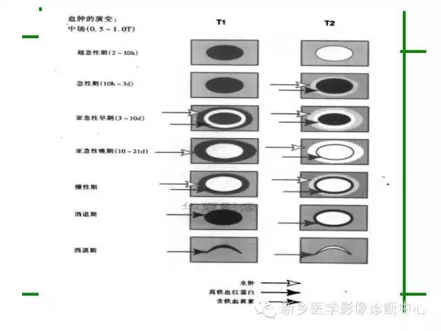 脑出血的CT和磁共振分期图解