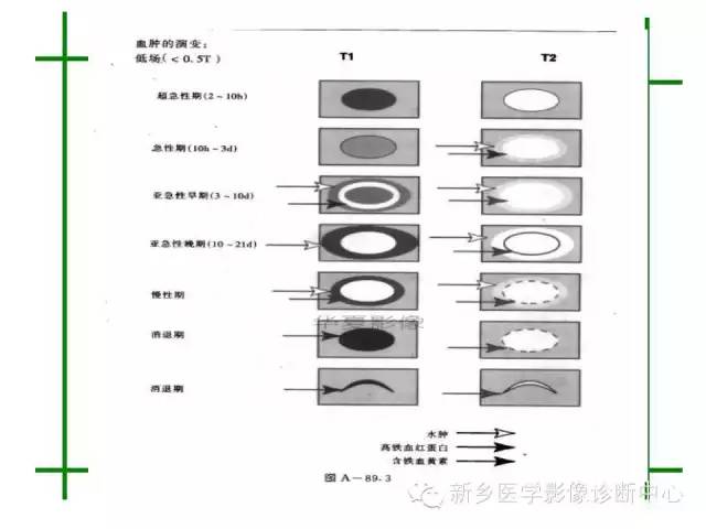 脑出血的CT和磁共振分期图解