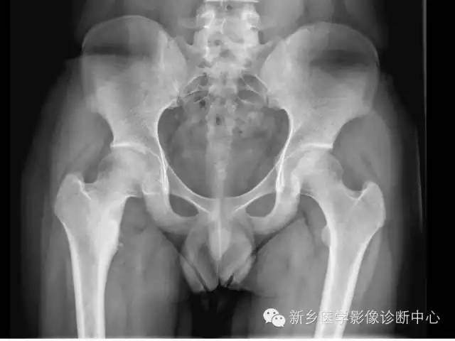 【病例】股骨骨样骨瘤1例影像表现