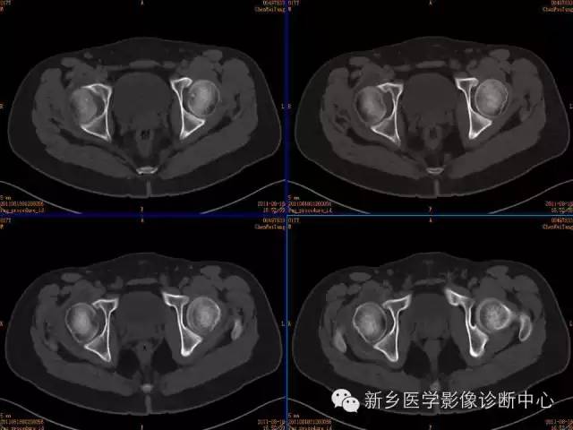 【病例】股骨骨样骨瘤1例影像表现