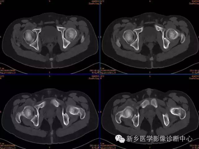【病例】股骨骨样骨瘤1例影像表现