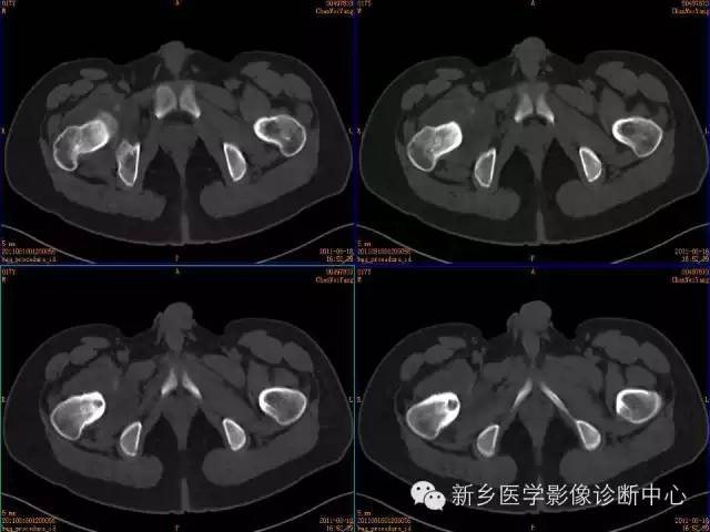 【病例】股骨骨样骨瘤1例影像表现