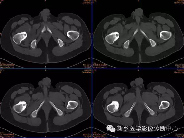 【病例】股骨骨样骨瘤1例影像表现