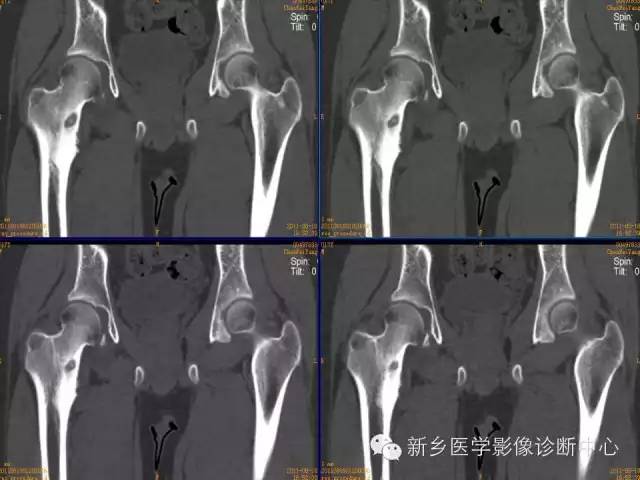 【病例】股骨骨样骨瘤1例影像表现