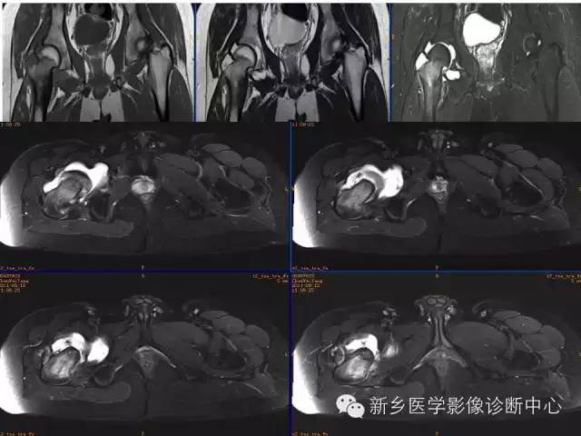 【病例】股骨骨样骨瘤1例影像表现