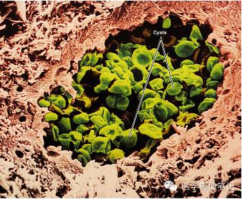 肺孢子菌肺炎Pneumocystis pneumonia，PCP