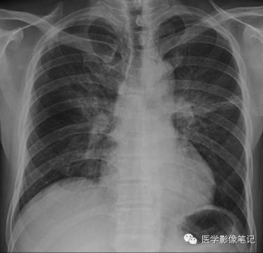 肺孢子菌肺炎Pneumocystis pneumonia，PCP