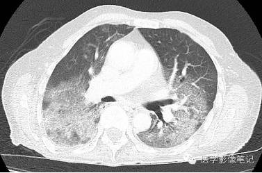 肺孢子菌肺炎Pneumocystis pneumonia，PCP