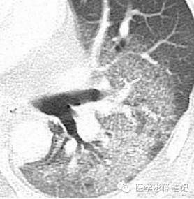 肺孢子菌肺炎Pneumocystis pneumonia，PCP