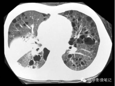肺孢子菌肺炎Pneumocystis pneumonia，PCP