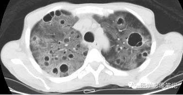 肺孢子菌肺炎Pneumocystis pneumonia，PCP