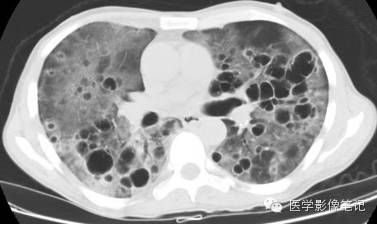 肺孢子菌肺炎Pneumocystis pneumonia，PCP