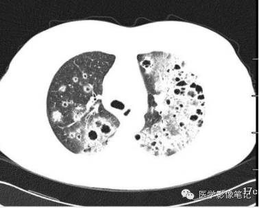 肺孢子菌肺炎Pneumocystis pneumonia，PCP