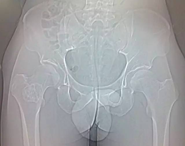 【病例】骨母细胞瘤1例影像表现 【病例】骨母细胞瘤1例影像表现