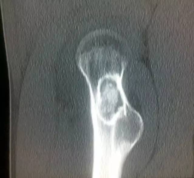 【病例】骨母细胞瘤1例影像表现 【病例】骨母细胞瘤1例影像表现