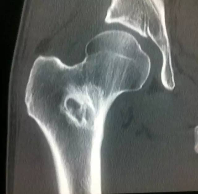 【病例】骨母细胞瘤1例影像表现 【病例】骨母细胞瘤1例影像表现