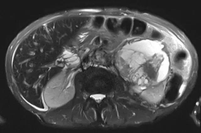 【病例】腹膜后肉瘤1例影像诊断要点 【病例】腹膜后肉瘤1例影像诊断要点