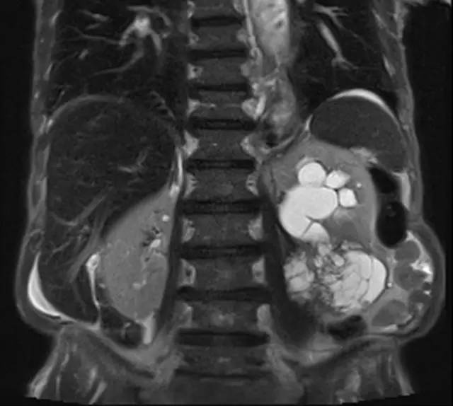 【病例】腹膜后肉瘤1例影像诊断要点 【病例】腹膜后肉瘤1例影像诊断要点