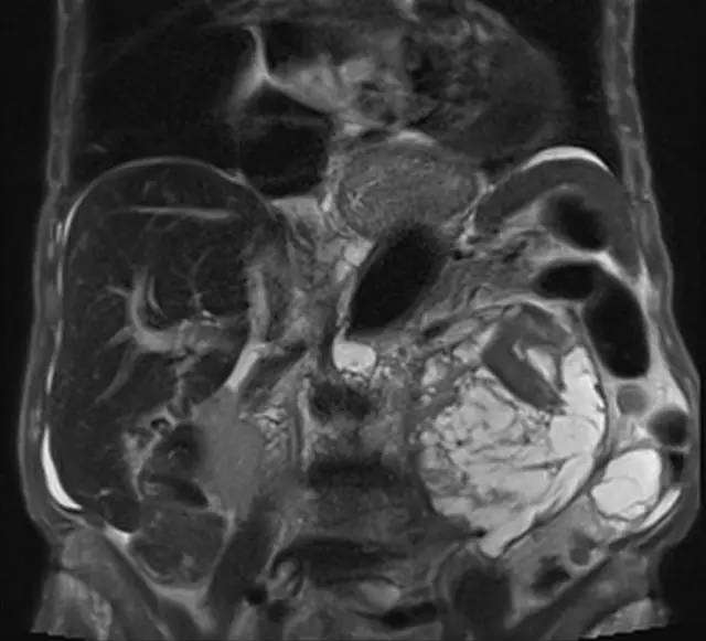 【病例】腹膜后肉瘤1例影像诊断要点 【病例】腹膜后肉瘤1例影像诊断要点