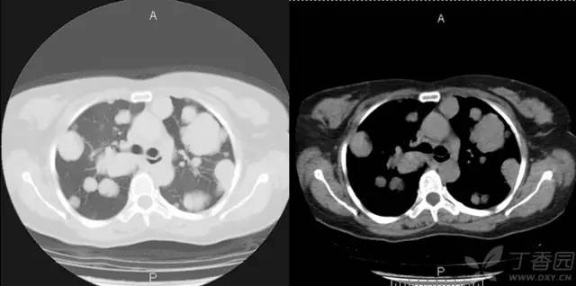【病例】肺转移性腺样囊性癌1例 【病例】肺转移性腺样囊性癌1例