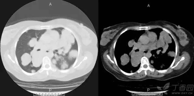 【病例】肺转移性腺样囊性癌1例 【病例】肺转移性腺样囊性癌1例