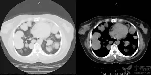 【病例】肺转移性腺样囊性癌1例 【病例】肺转移性腺样囊性癌1例