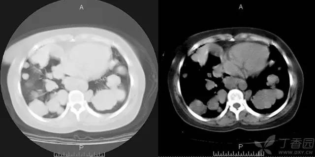 【病例】肺转移性腺样囊性癌1例 【病例】肺转移性腺样囊性癌1例