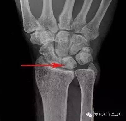 尺骨撞击综合征