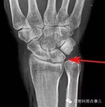 尺骨撞击综合征 尺骨撞击综合征