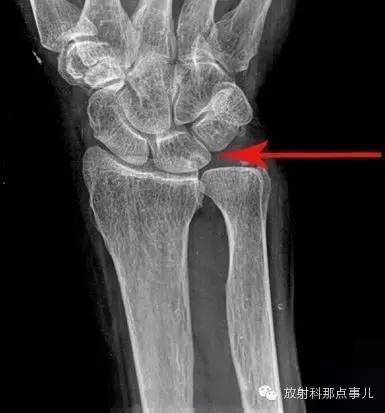 尺骨撞击综合征 尺骨撞击综合征