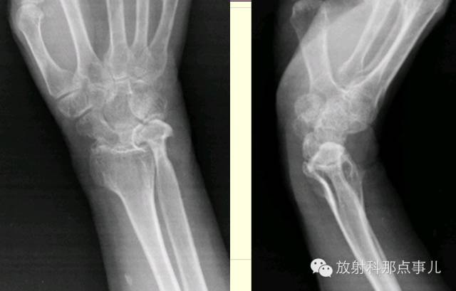 尺骨撞击综合征 尺骨撞击综合征