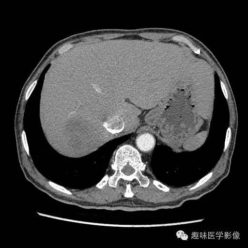 【病例】肝脓肿1例CT影像表现 【病例】肝脓肿1例CT影像表现