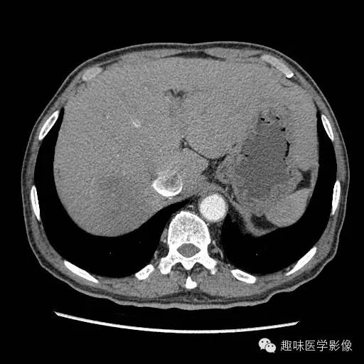 【病例】肝脓肿1例CT影像表现 【病例】肝脓肿1例CT影像表现
