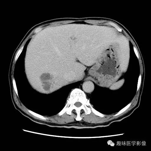 【病例】肝脓肿1例CT影像表现 【病例】肝脓肿1例CT影像表现