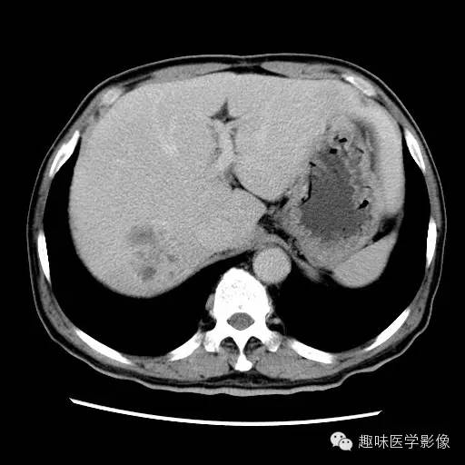 【病例】肝脓肿1例CT影像表现 【病例】肝脓肿1例CT影像表现