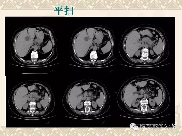 【病例】胰腺结核1例CT影像表现 【病例】胰腺结核1例CT影像表现