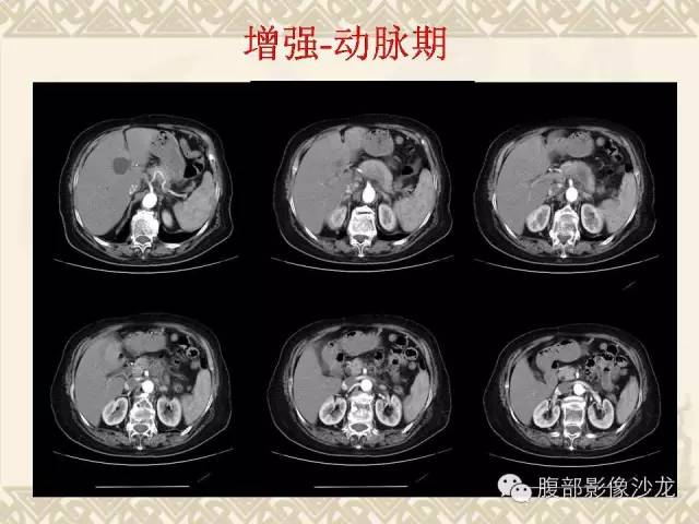 【病例】胰腺结核1例CT影像表现 【病例】胰腺结核1例CT影像表现