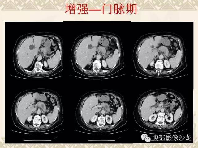 【病例】胰腺结核1例CT影像表现 【病例】胰腺结核1例CT影像表现