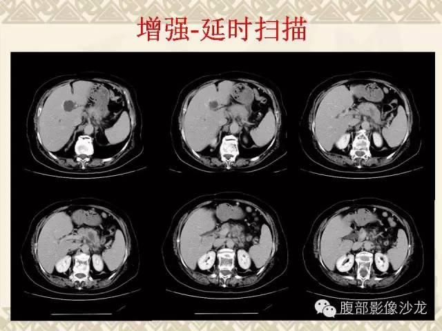 【病例】胰腺结核1例CT影像表现 【病例】胰腺结核1例CT影像表现