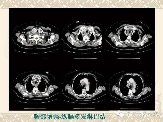 【病例】胰腺结核1例CT影像表现 【病例】胰腺结核1例CT影像表现