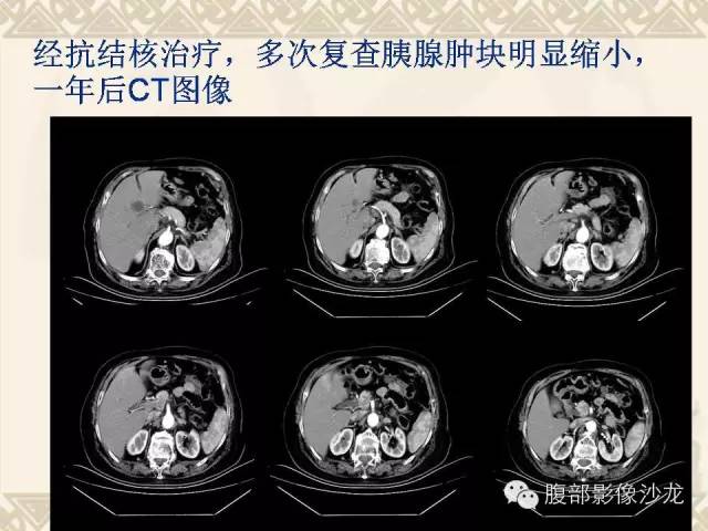 【病例】胰腺结核1例CT影像表现 【病例】胰腺结核1例CT影像表现