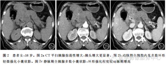 【病例】胰腺结核1例CT影像表现 【病例】胰腺结核1例CT影像表现