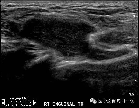 【病例】努克管鞘膜积液1例影像表现 【病例】努克管鞘膜积液1例影像表现