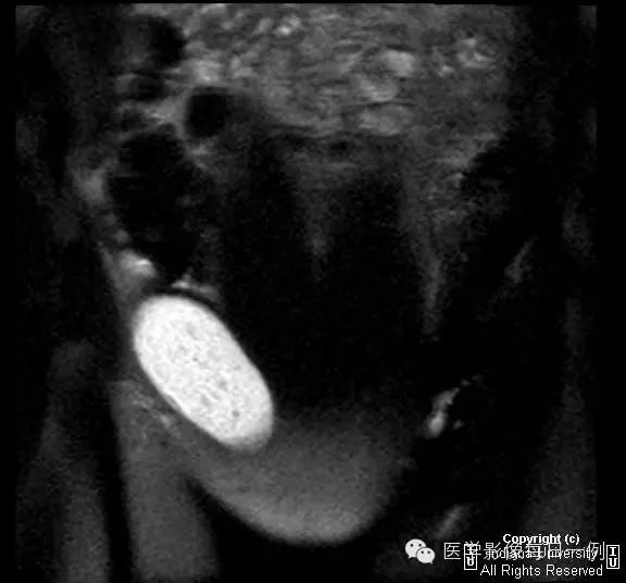 【病例】努克管鞘膜积液1例影像表现