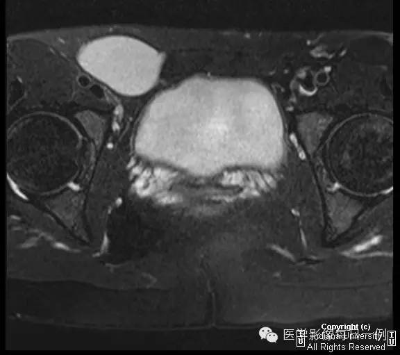 【病例】努克管鞘膜积液1例影像表现 【病例】努克管鞘膜积液1例影像表现