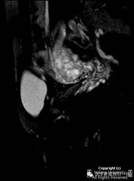【病例】努克管鞘膜积液1例影像表现 【病例】努克管鞘膜积液1例影像表现