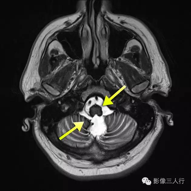中枢神经系统铁质沉积症